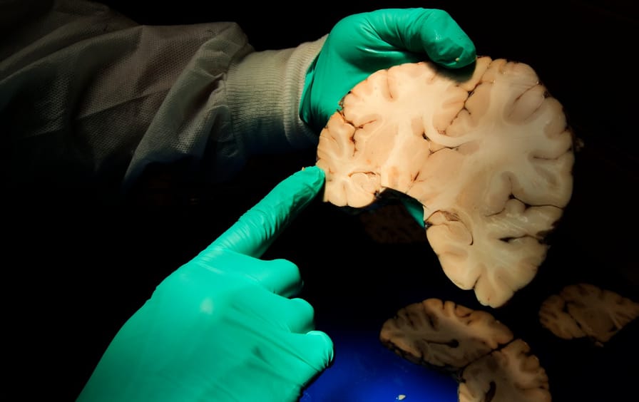 CTE brain tissue
