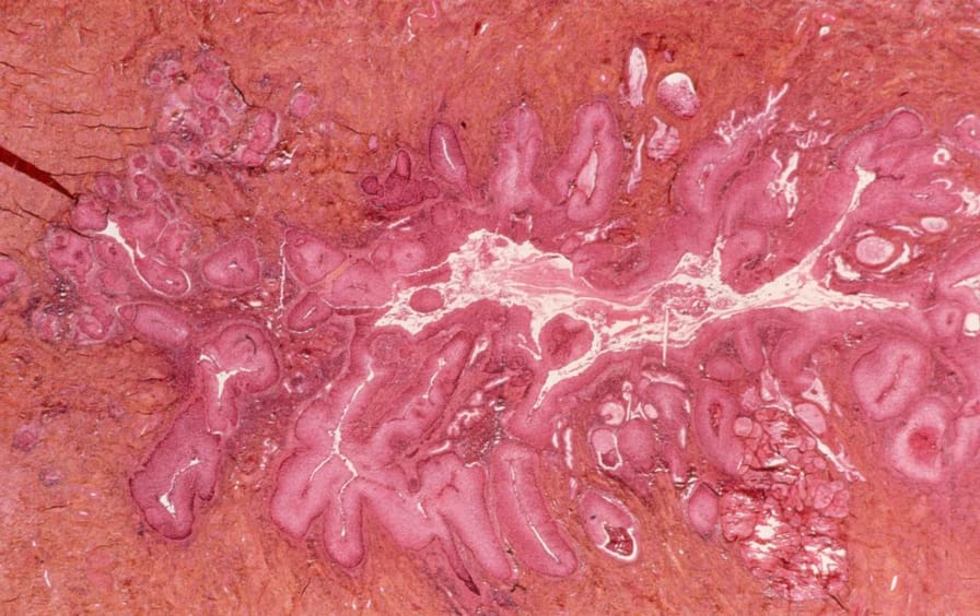 cervical cancer stock photo
