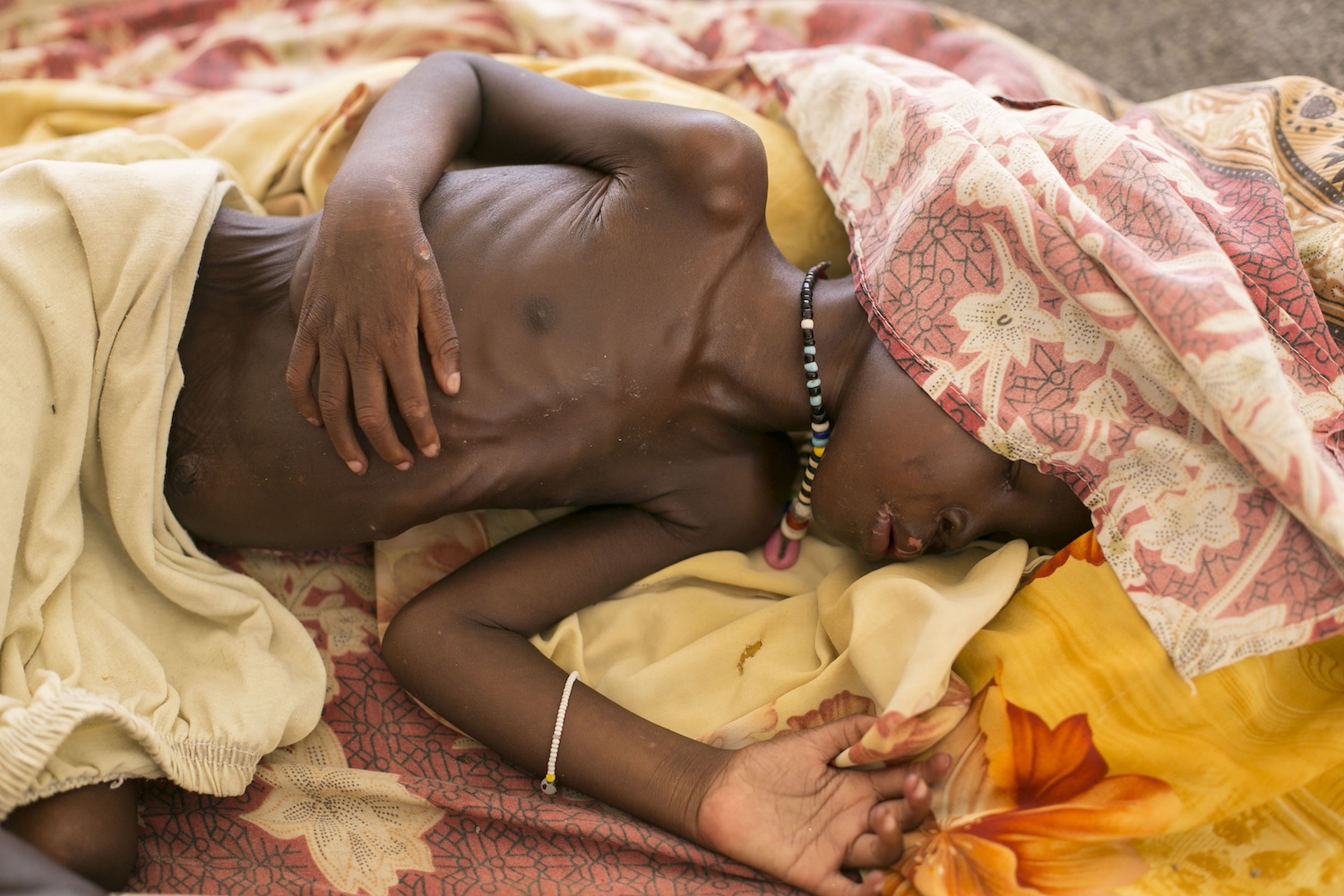 Why Are 50,000 South Sudanese Children on the Brink of Death?