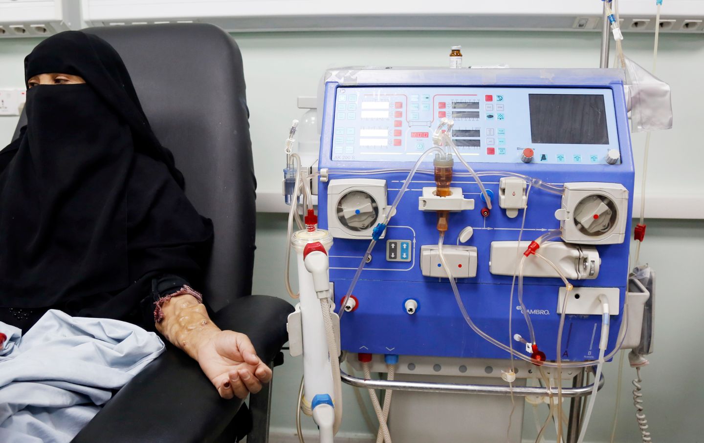 a patient suffering from kidney failure receives dialysis treatment in Yemen