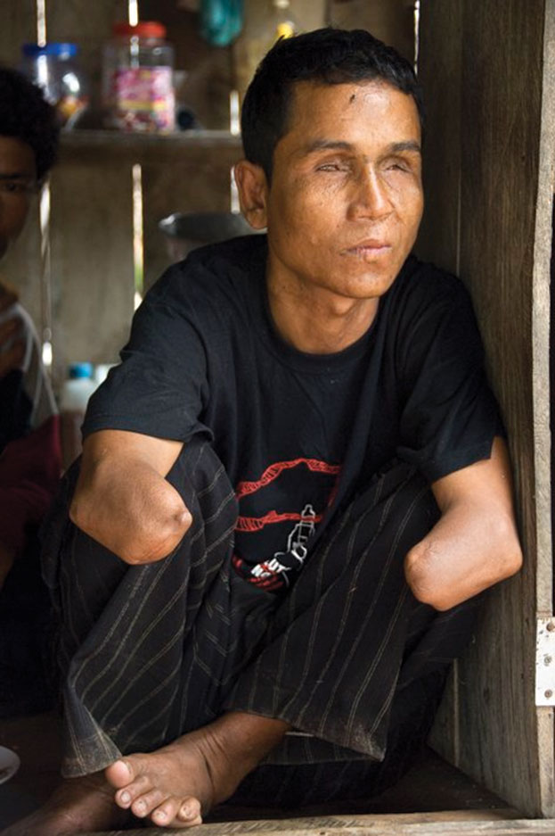 Land mines have permanently disabled many Cambodians.