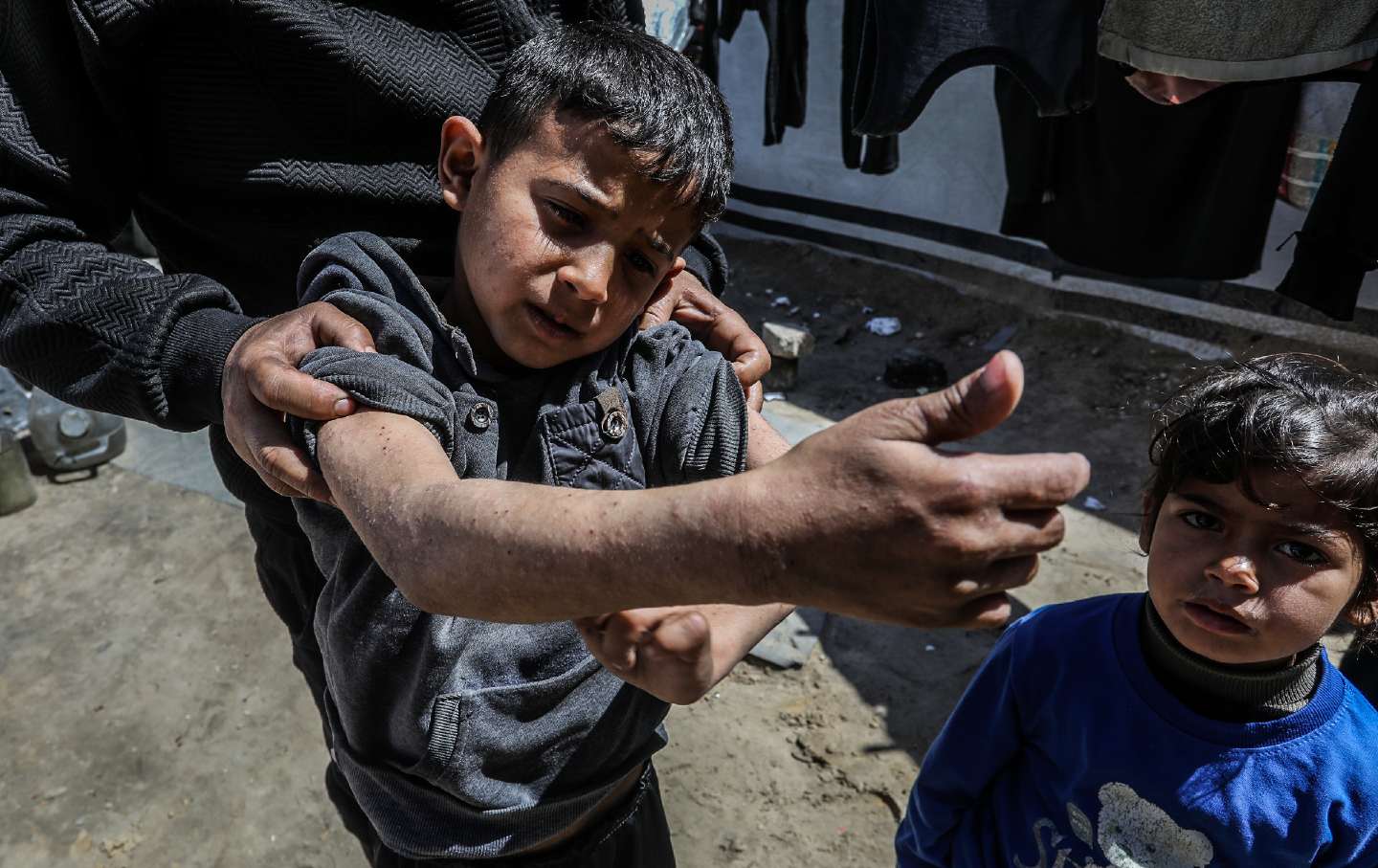 A Palestinian boy displays the bites he has received from vermin, in Khan Yunis, Gaza, Palestine, on March 30, 2026.